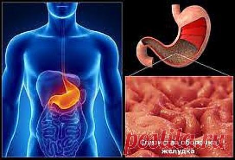 Гастрит. Лечение гомеопатией..