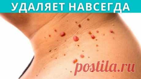Как НАВСЕГДА избавиться от БОРОДАВОК и ПАПИЛЛОМ — Смотреть в Эфире Бородавки и папилломы могут появиться в любой части тела и они вызывают неудобства. Способов удаления много, я вам покажу наиболее бюджетный и натура…