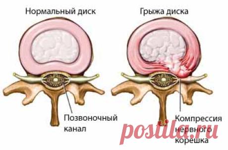 Болезни позвоночника