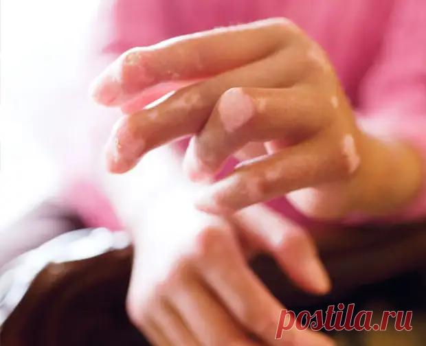 Народные рецепты лечения склеродермии - Народная медицина - медиаплатформа МирТесен