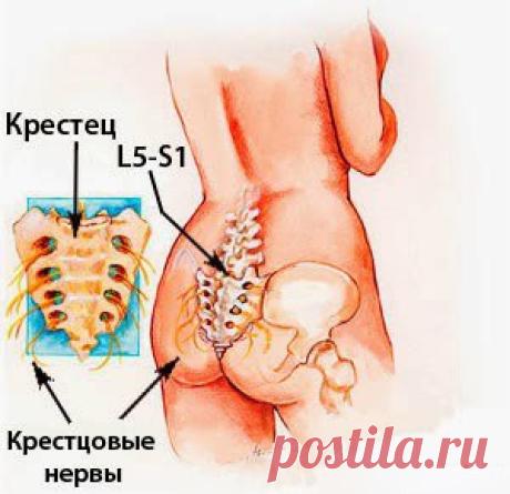 Профилактика и лечение остеохондроза.