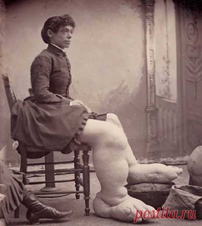 Трудно поверить, но эти 5 человек с аномалиями действительно существовали! Их истории невероятны...