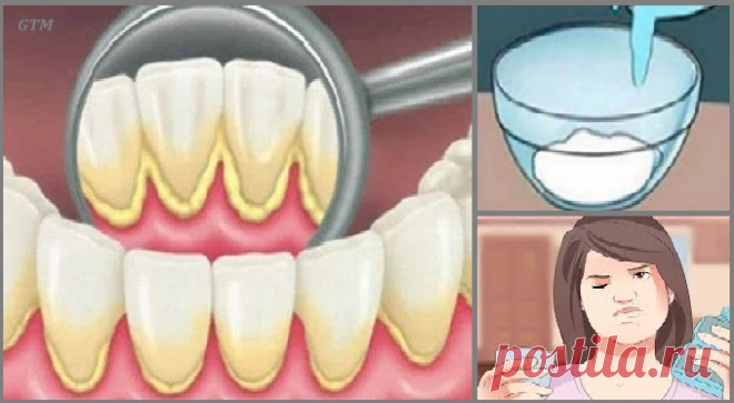 Это полоскание для рта удаляет зубной налет из зубов за 2 минуты Избавляемся раз и навсегда!