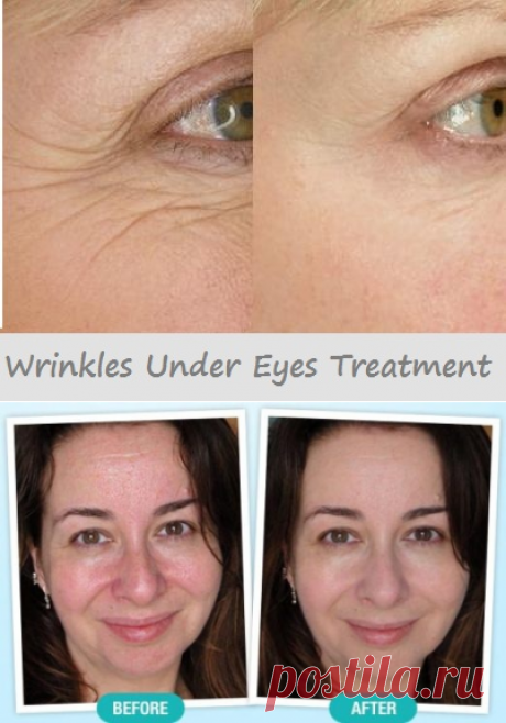 Top 10 Home Remedies for Wrinkles | Virtual Clinic