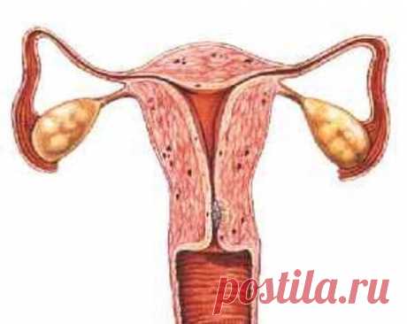 A MATRIZ.
Todas as mulheres nascem com este órgão maravilhoso.
Seu tamanho normal é de cerca de 7 centímetros de comprimento e 5 centímetros de largura. Este órgão expande mais de 100 vezes para abrigar um feto.
Todo mês, autodestrói-se e volta a ser construído, através disso, elimina a menstruação por contrações, por isso a dor menstrual, é dor de útero, não de ovários.