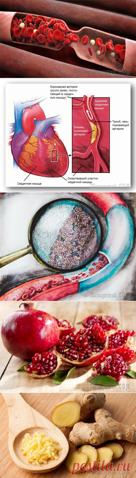 От тромбоза до тромбона – один шаг. 5 простых и надёжных советов, чтобы жить долго без тромбов