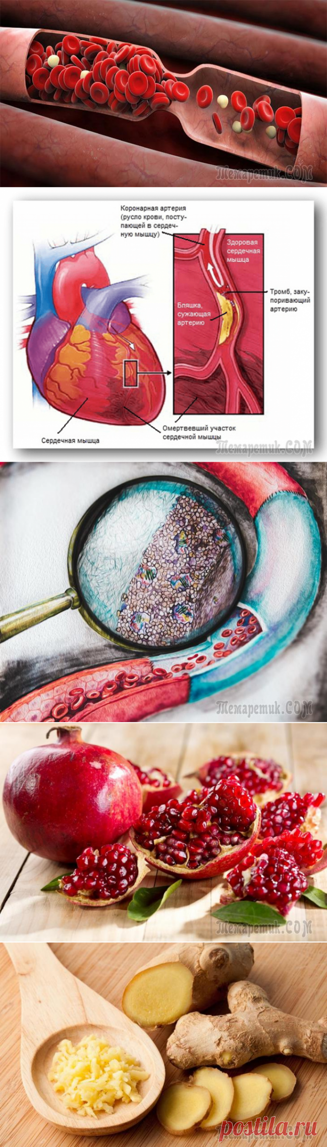 От тромбоза до тромбона – один шаг. 5 простых и надёжных советов, чтобы жить долго без тромбов