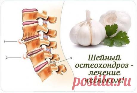 Шейный остеохондроз - лечение чесноком! 
Шейный остеохондроз - очень частое заболевание как среди взрослых людей, так и молодых. Заболевание очень неприятное и лечиться в основном правильным массажем, специальными упражнениями в сочетании с некоторыми лекарственными препаратами, например, чесноком. 
Лекарственное растение – чеснок применяется не только на кухне и для профилактики простудных заболеваний, но и в составе рецептов при остеохондрозе. 
Представляем Вашему вниманию несколько таких р