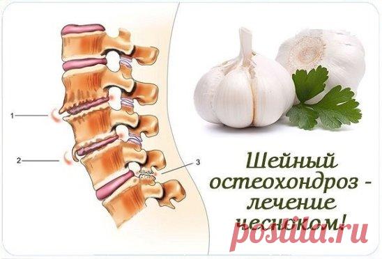 Шейный остеохондроз - лечение чесноком! 
Шейный остеохондроз - очень частое заболевание как среди взрослых людей, так и молодых. Заболевание очень неприятное и лечиться в основном правильным массажем, специальными упражнениями в сочетании с некоторыми лекарственными препаратами, например, чесноком. 
Лекарственное растение – чеснок применяется не только на кухне и для профилактики простудных заболеваний, но и в составе рецептов при остеохондрозе. 
Представляем Вашему вниманию несколько таких р