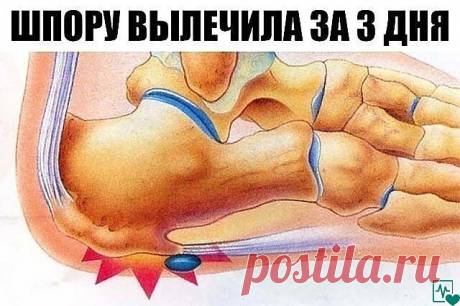 ШПОРУ ВЫЛЕЧИЛА ЗА 3 ДНЯ
 
Поделюсь рецептами от пяточных шпор. Прошлым летом на юге после ванн у меня так разболелась нога, что я не знала, куда ее деть. Пятка горела огнем. Приехав домой, побежала к хирургу. Молодая врач сделала снимок и объявила, что у меня после ванн обострилась пяточная шпора. Дала мне какую-то «памятку» - и все. Я поняла, что надо самой лечиться. Обратилась к народной медицине - стала искать рецепты от шпор. Все, что нашла, выписала и посылаю вам. Вед...