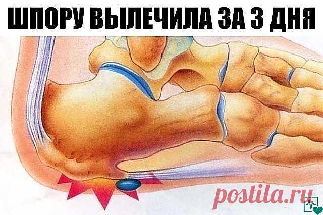 ШПОРУ ВЫЛЕЧИЛА ЗА 3 ДНЯ
 
Поделюсь рецептами от пяточных шпор. Прошлым летом на юге после ванн у меня так разболелась нога, что я не знала, куда ее деть. Пятка горела огнем. Приехав домой, побежала к хирургу. Молодая врач сделала снимок и объявила, что у меня после ванн обострилась пяточная шпора. Дала мне какую-то «памятку» - и все. Я поняла, что надо самой лечиться. Обратилась к народной медицине - стала искать рецепты от шпор. Все, что нашла, выписала и посылаю вам. Вед...