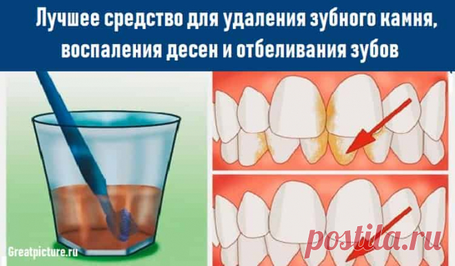Лучшее средство для удаления зубного камня,и отбеливания зубов Лучшее средство для удаления зубного камня, воспаления десен и отбеливания зубов.Здоровье полости рта влияет на наше общее здоровье