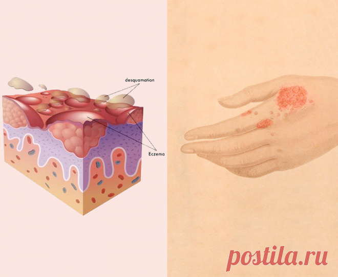 Как лечить дерматит и экзему без гормонов. Рибофлавин Кожные заболевания часто требуют длительного лечения. Терапия дерматологических недугов включает гормональные препараты, но не все пациенты хотят использовать такие лекарства. Оказывается, витамины оказывают позитивный эффект на здоровье кожи. Среди них — рибофлавин (витамин В2).