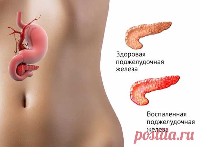 Воспаление паренхимы поджелудочной железы или панкреатит
