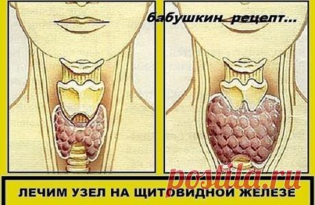 ЛЕЧИМ УЗЕЛ НА ЩИТОВИДНОЙ ЖЕЛЕЗЕ 
Смешайте по одному стакану молотой гречневой крупы, пропущенных через мясорубку грецких орехов и меда в эмалированной (абсолютно чистой) посуде и переложите в стеклянную банку. 
Один раз в неделю за целый день съешьте этот состав, не принимая больше никакой пищи, кроме воды. 
Сделайте так шесть раз, т. е. шесть недель. 
Затем через месяц повторите лечение. 
Уже после первого курса зоб уменьшится, а после второго болезнь оставит вас. Проверьтесь на УЗИ: щитов