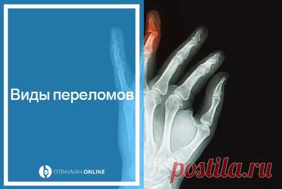 Как выглядит сломанный палец на руке 🔎 - виды переломов