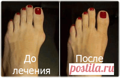 #Вальгусная деформация: симптомы, причины и лечение.