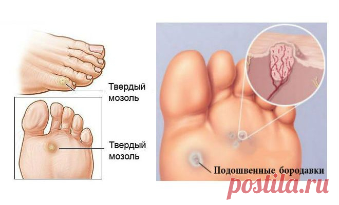 Мозоли и бородавки на ногах: как от них избавиться? Лучший способ, который действительно работает!
