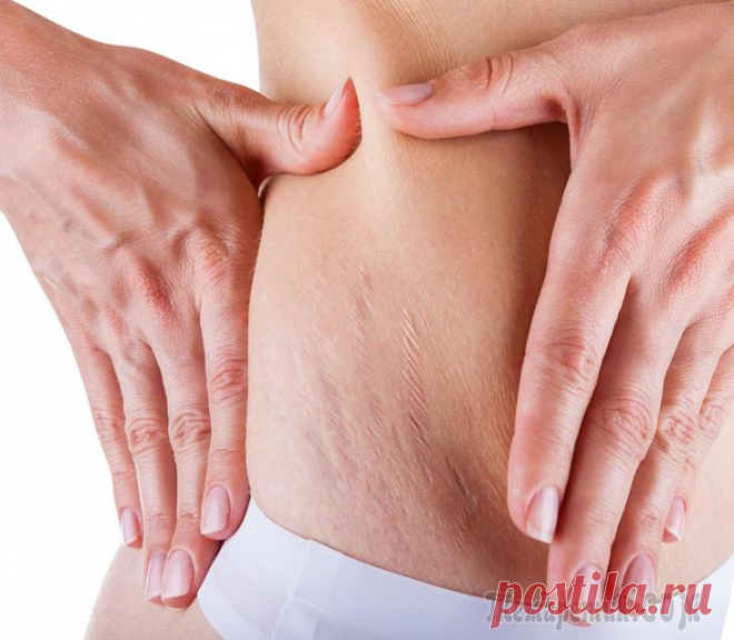 Мумие от растяжек - применение в домашних условиях Растяжки – коварные враги любой женщины, которые появляются легко, а исчезать не торопятся. Существует множество современных средств, которые помогают бороться с этой напастью. Большинство из них изго...