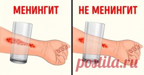 8 симптомов менингита, о которых должен знать каждый родитель Менингит — это заболевание, связанное с воспалением оболочек головного и спинного мозга. Этиология этой болезни может быть разной, но симптомы у различных видов, как правило, схожи. Считается, что наиболее подвержены этой болезни дети. Поэтому 365NEWS решили напомнить родителям о том, как распознать у ребенка менингит и на какие симптомы следует обратить внимание в первую очередь. Внезапная лихорадка       Одним...