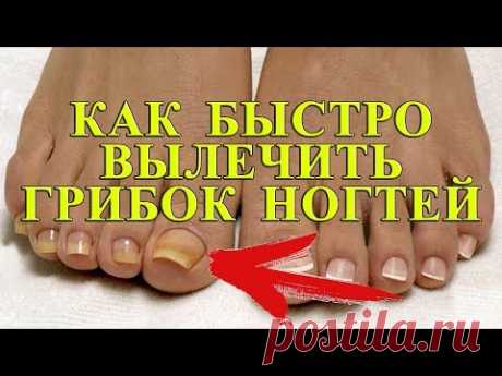 КАК БЫСТРО ВЫЛЕЧИТЬ ГРИБОК НОГТЕЙ