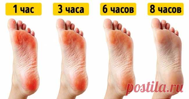 11 легких способов вылечить мозоль от неудобной обуви | Милая Я Напасть всех любителей красивой обуви существует в двух состояниях. Сухом — твердые, плотные мозоли, похожи на натоптыши. Мокром — волдыри, которые рискуют лопнуть в любой момент. Хорошая новость: и те и другие лечатся, только по-разному. Milayaya.ru придет на помощь тем, кто настрадался от дискомфорта, но настоятельно рекомендует обратиться к специалистам, прежде чем заниматься самолечением. Как вылечить мокр...