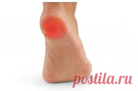 ШПОРУ ВЫЛЕЧИЛА ЗА 3 ДНЯ
Поделюсь рецептами от пяточных шпор. Прошлым летом на юге после ванн у меня так разболелась нога, что я не знала, куда ее деть. Пятка горела огнем. Приехав домой, побежала к хирургу. Молодая врач сделала снимок и объявила, что у меня после ванн обострилась пяточная шпора. Дала мне какую-то «памятку» - и все. Я поняла, что надо самой лечиться. Обратилась к народной медицине - стала искать рецепты от шпор. Все, что нашла, выписала и посылаю вам. Ведь ...