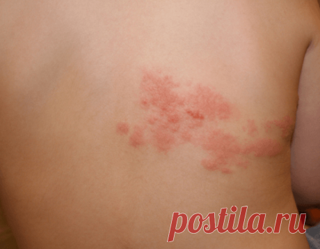 Народные методы лечения опоясывающего лишая