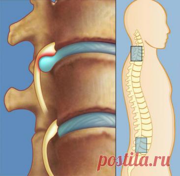 Узкий специалист: «Лечение межпозвоночной грыжи без лекарств, без операции! Нужно лишь упорно…» — Journal women❜s