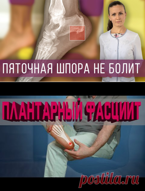 (811) Боль в пятке: пяточная шпора, плантарный фасциит. Причины, симптомы, как лечить. - YouTube