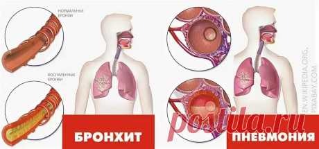 Как отличить бронхит от пневмонии
Отличить пневмонию от бронхита пациенту не всегда легко. В зависимости от степени тяжести в обоих случаях могут быть похожие симптомы, а также способы предотвращения обоих состояний.   Отказ от курения и вакцинация против гриппа и пневмококка, несомненно, являются наиболее распространенными и эффективными методами профилактики. Ниже мы перечислим основные характеристики и различия между пневмонией и бронхитом. […]
Читай пост далее на сайте. Жми ⏫ссылку выше