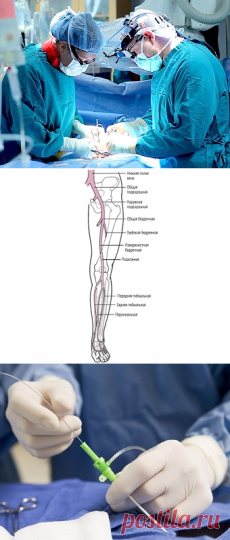 Тромбэктомия из артерий нижних конечностей: цена операции в Москве