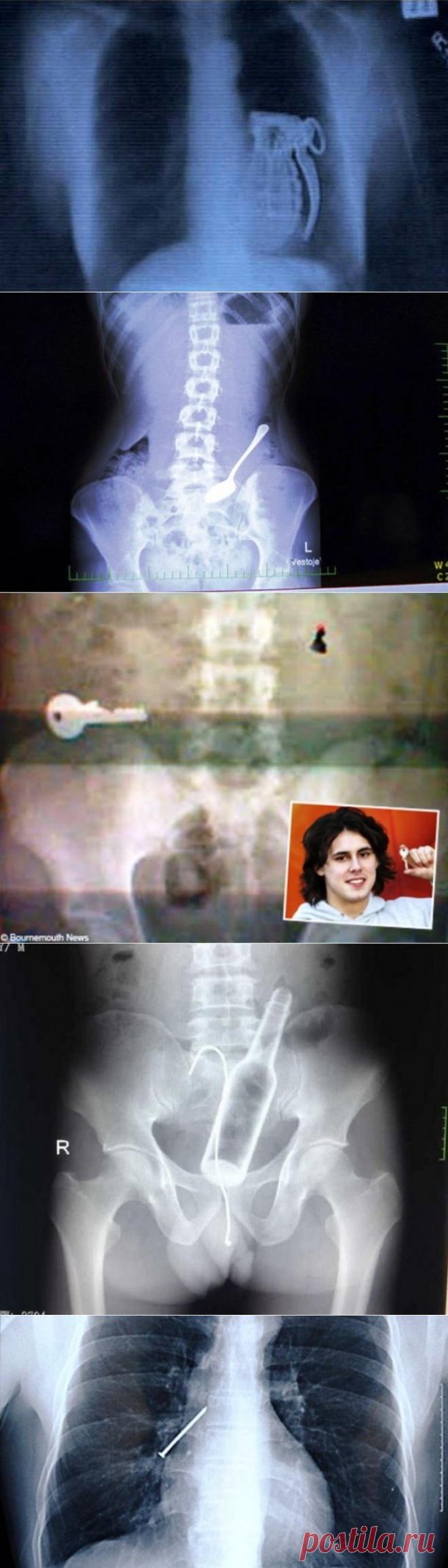 (+1) тема - Самые невероятные предметы, которые были найдены в человеческом теле | НАУКА И ЖИЗНЬ