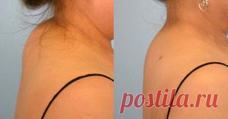 Вдовий горб: Как избавиться от холки Вдовий горб следует лечить на начальных стадиях возникновения. Для этого следует убрать причину, которая провоцирует патологию. Вдовий горб (холка) – это скопление жира в проекции C7 (седьмой шейный п...