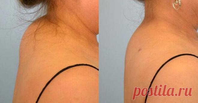 Вдовий горб: Как избавиться от холки Вдовий горб следует лечить на начальных стадиях возникновения. Для этого следует убрать причину, которая провоцирует патологию. Вдовий горб (холка) – это скопление жира в проекции C7 (седьмой шейный п...