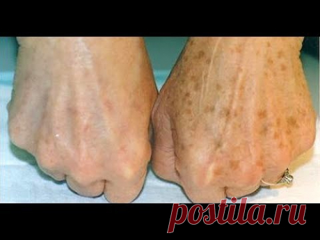 Увидев коричневые ПЯТНЫШКИ НА РУКАХ, она ужаснулась! Хорошо, что под рукой БЫЛО ЭТО…
