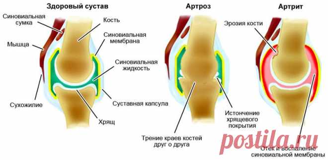Артрит-артроз - как лечить без операции и лекарств?!