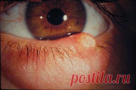 ЛЕЧЕНИЕ БЛЕФАРИТА НЕТРАДИЦИОННЫМИ МЕТОДАМИ. | Познавательный сайт ,,1000 мелочей"