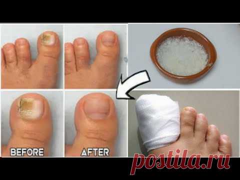 Пока, гвоздь, раздражение!  Вы должны это сделать !!!!  *** ОЧЕНЬ ВАЖНЫЙ СОВЕТ ***