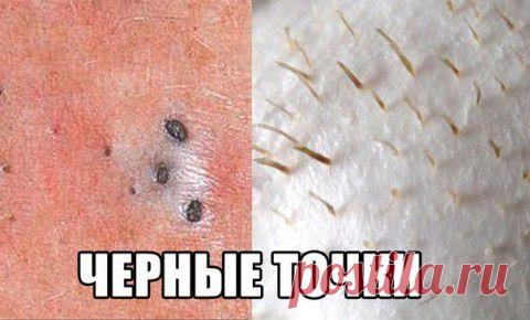 Удаление черных точек. Работающий метод. Почитайте | Мамам, женщинам, бабушкам и очень любознательным.