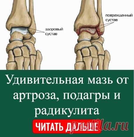Удивительная мазь от артроза, подагры и радикулита.