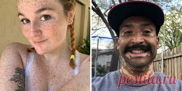 35 фото людей со странными физиологическими особенностями, обусловленными генетическими аномалиями - ПолонСил.ру - социальная сеть здоровья - Медиаплатформа МирТесен Каждый из нас уникален, имея внешность, отличающуюся от внешности других человеческих индивидуумов. Как известно, даже отпечатки пальцев у всех настолько разные, что по ним правоохранительные службы разыскивают преступников. Но есть еще более уникальные люди, имеющие такие физиологические - 14 февраля - 439418...