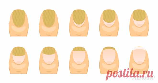 Все, что нужно знать о грибке ногтей, чтобы вовремя обнаружить проблему | Милая Я У вас обесцвеченные или ломкие ногти? Наверняка это заставляет вас задумываться, прежде чем надевать босоножки с открытым носком. Есть на кого переложить ответственность – грибковая инфекция! Или, как говорят медики, онихомикоз. Как правило, болезнь атакует ноготь на большом пальце. Инфекция развивается по бокам ногтя и редко – от корня. Но этого знать мало! Обо всех проявлениях онихомикоза п...