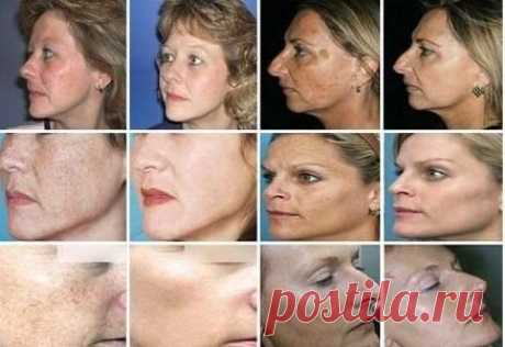 Пигментация. Причины и лечение