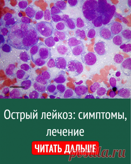 Острый лейкоз: симптомы, лечение