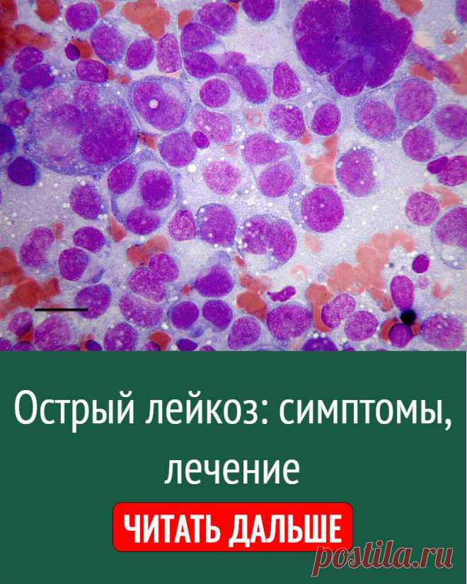 Острый лейкоз: симптомы, лечение