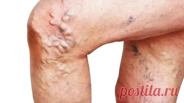 Варикозное расширение вен - Я ЗДОРОВ! - медиаплатформа МирТесен