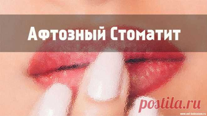 Что следует знать про афтозный стоматит: Симптомы, причины и лечение болезни
Афтозный стоматит - это неприятное нарушение полости рта, которое характеризуется появлением маленьких болезненных язвочек в форме кратеров с красными краями.
