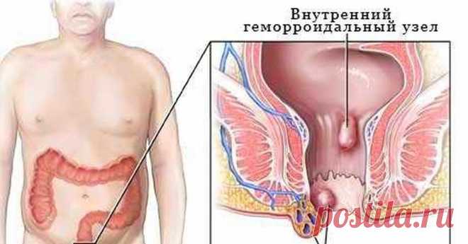 Это устраняет геморрой навечно за 5 дней!