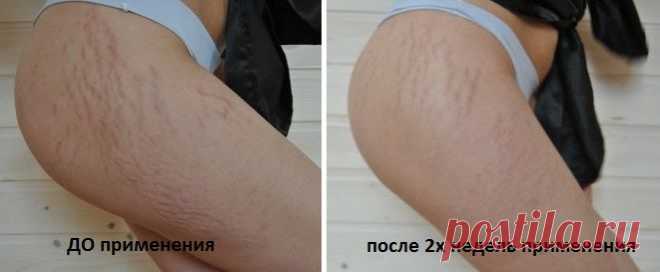 Крем от растяжек с мумиё. Рецепт крема от растяжек с мумие, отзывы.